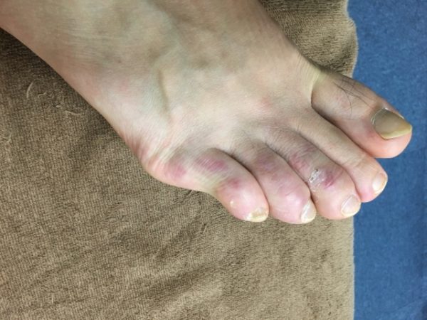 小指 た の 痛い ぶつけ 足 足の指をぶつけた！骨折かも？だとしたらその症状は？